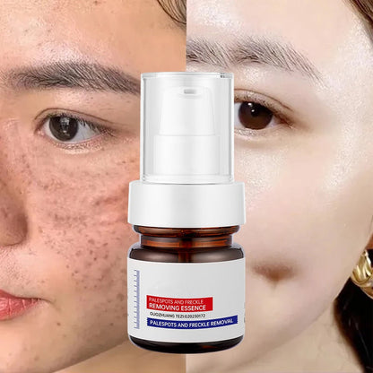🔥Final 3 Hours – 50% OFF!🔥⚡5-second brightening rescue: Dark spots disappear, blemishes fade, and skin becomes radiant! Vitamin C Whitening Freckles