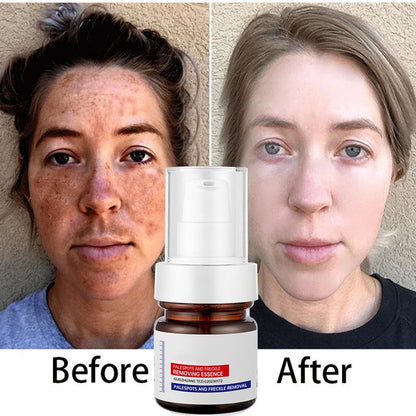 🔥Final 3 Hours – 50% OFF!🔥⚡5-second brightening rescue: Dark spots disappear, blemishes fade, and skin becomes radiant! Vitamin C Whitening Freckles