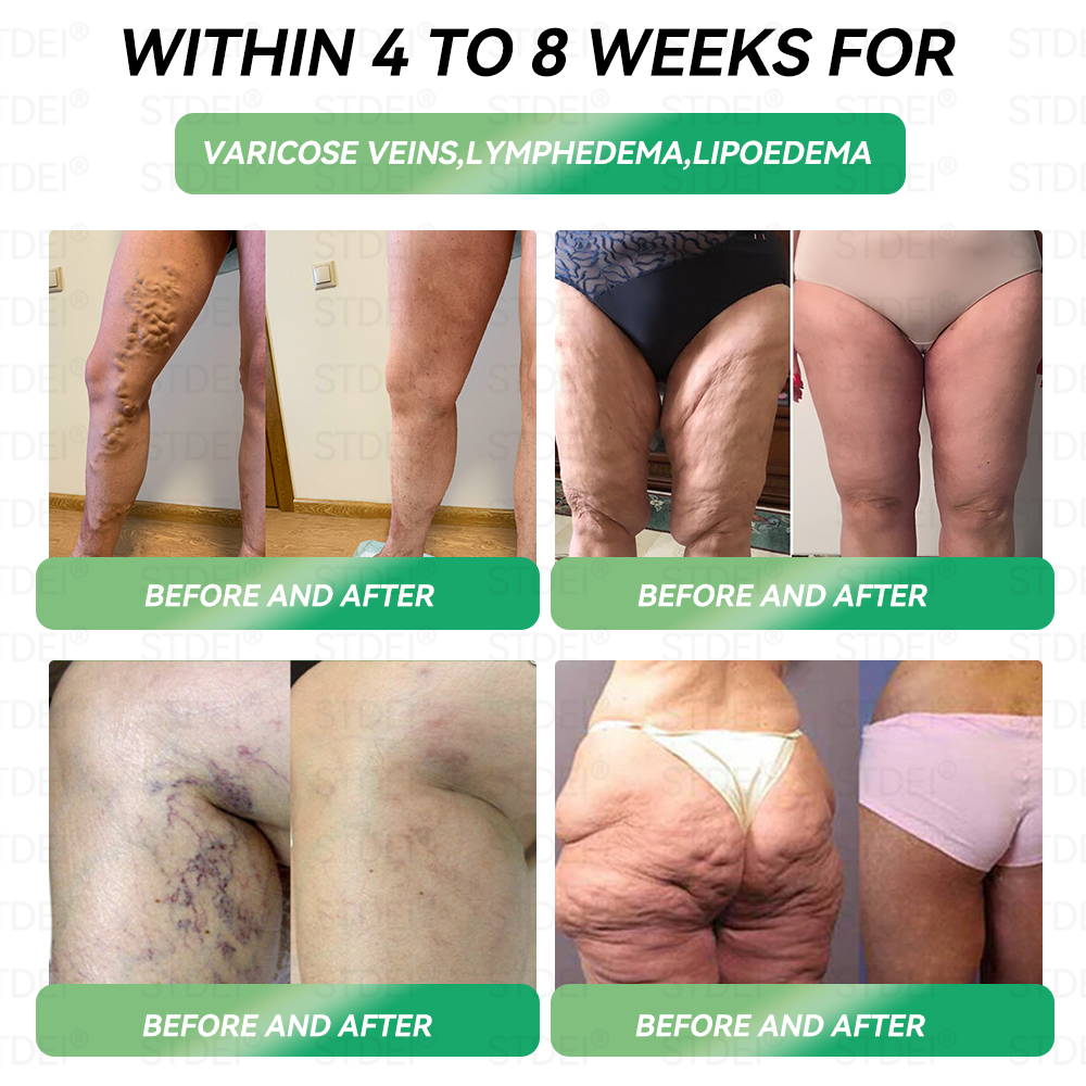 🔥Hot Sale🎁GLP-1 Microcapsule Burst Patch——👩‍⚕️A Breakthrough in Weight Loss and Blood Sugar Management💪