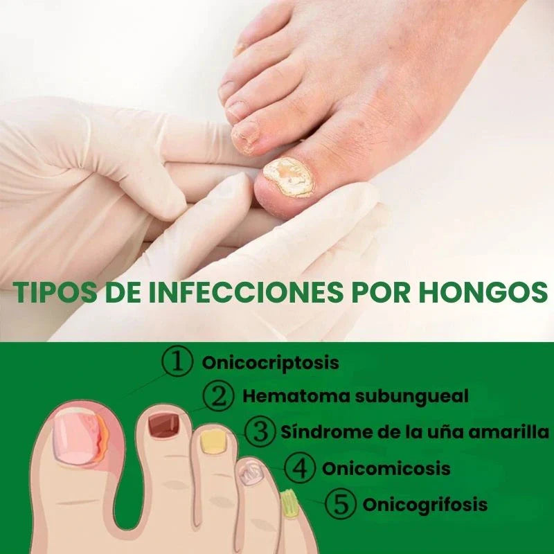 🔥Hot Sale 50% Off🎁7 DAYS NAIL FUNGUS TREATMENT - Protege y elimina el hongo de tus Uñas